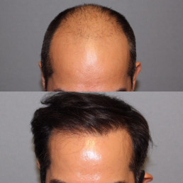 hair restoration transplant
