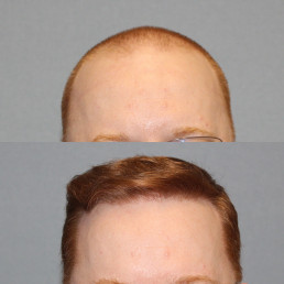 Hair Transplant Before and After