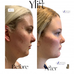 YLift Before and After