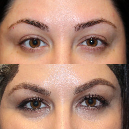 Eyebrows Hair Transplant Before and After
