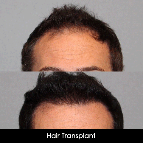 Hair Restoration Before and After Examples
